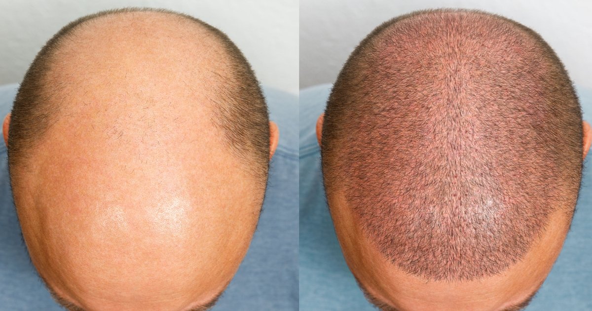 Complete Guide to Hair Transplant: Process, Benefits & Career Opportunities